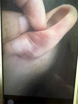 '劉兵歡受迫害後的傷'