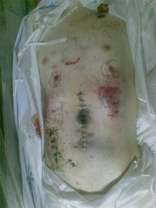 '圖：徐浪舟遺體血瘀斑駁，慘遭重毆（攝於死後第三天）'